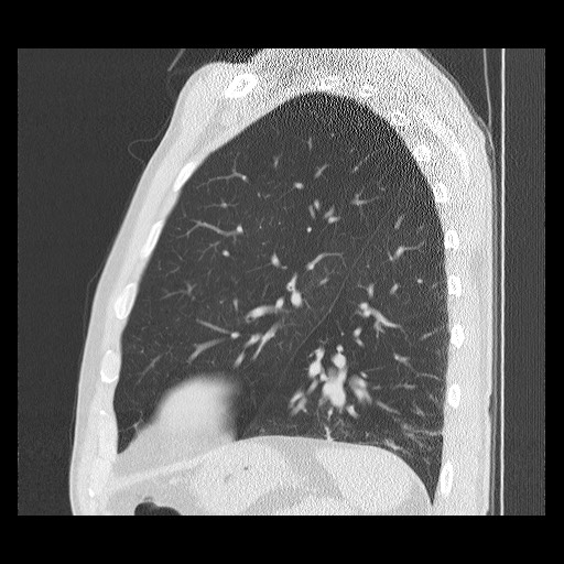 Allergic bronchopulmonary aspergillosis (ABPA) (Radiopaedia 60594-68313 Sagittal lung window 15).jpg