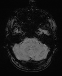 File:Alzheimer's disease- with Gerstmann syndrome and dressing apraxia (Radiopaedia 54882-61150 Axial SWI 7).png