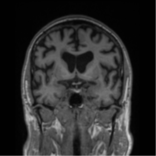 Alzheimer's disease- with Gerstmann syndrome and dressing apraxia (Radiopaedia 54882-61150 Coronal T1 54).png