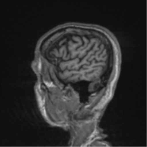 File:Alzheimer's disease- with apraxia (Radiopaedia 54763-61011 Sagittal T1 62).png