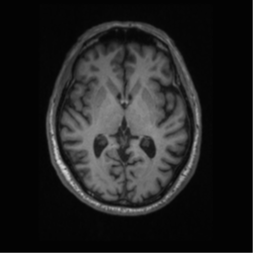 Alzheimer disease - probable (Radiopaedia 35334-36837 Axial T1 40).png