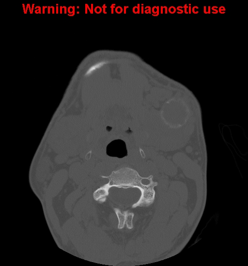 File:Ameloblastoma (Radiopaedia 13276-13280 Axial non-contrast 4).jpg