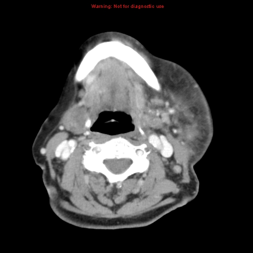 Ameloblastoma (Radiopaedia 27437-27631 A 53).jpg