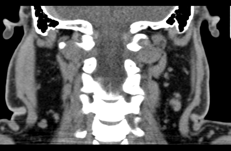 File:Ameloblastoma (Radiopaedia 33677-34806 Coronal non-contrast 51).png