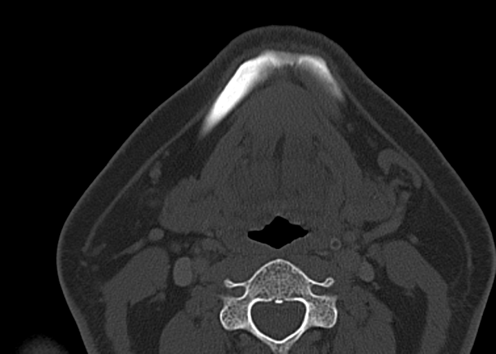 Ameloblastoma (Radiopaedia 38520-40623 D 39).png