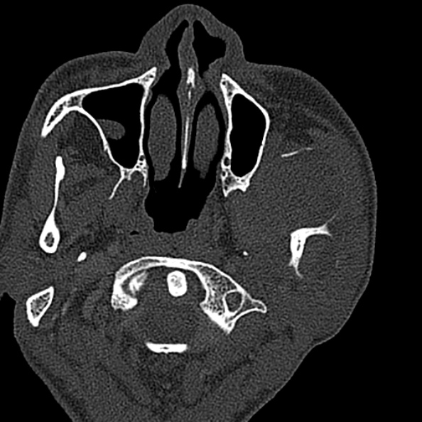 Ameloblastoma (Radiopaedia 51921-57766 Axial bone window 116).jpg