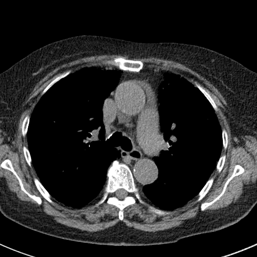 File:Amiodarone-induced pulmonary fibrosis (Radiopaedia 82355-96460 Axial non-contrast 26).jpg