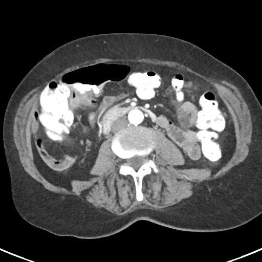 Ampullary adenocarcinoma (Radiopaedia 34013-35237 B 52).png