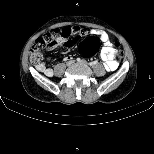 Ampullary adenocarcinoma (Radiopaedia 86093-102032 A 39).jpg