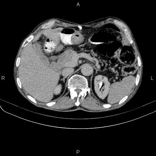 Ampullary adenocarcinoma (Radiopaedia 86093-102033 Axial C+ delayed 33).jpg