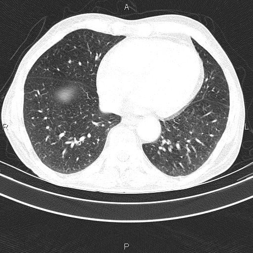 Ampullary adenocarcinoma (Radiopaedia 86093-102033 Axial lung window 42).jpg