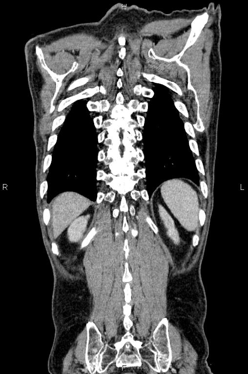 Ampullary adenocarcinoma (Radiopaedia 86093-102033 D 54).jpg
