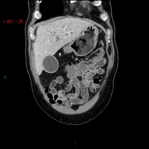 Ampullary carcinoma (Radiopaedia 56396-63056 E 24).jpg