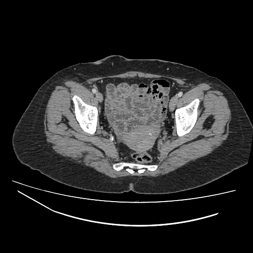 Ampullary tumor (Radiopaedia 60333-67998 A 80).jpg