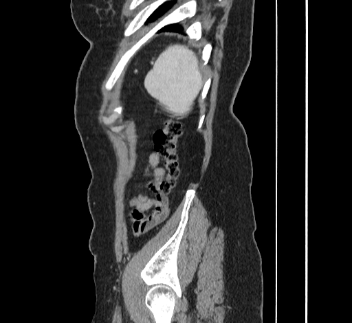 File:Ampullary tumor (Radiopaedia 60333-67998 C 54).jpg