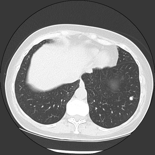 Amyloidosis - bronchial and diffuse nodular pulmonary involvement (Radiopaedia 60156-67744 B 46).jpg