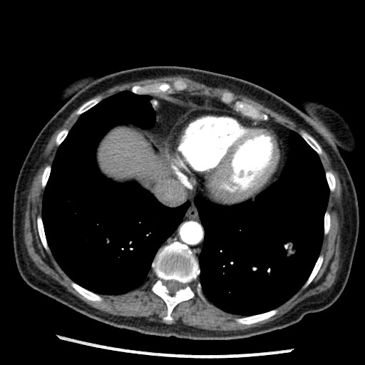 Amyloidosis - bronchial and diffuse nodular pulmonary involvement (Radiopaedia 60156-67745 A 41).jpg