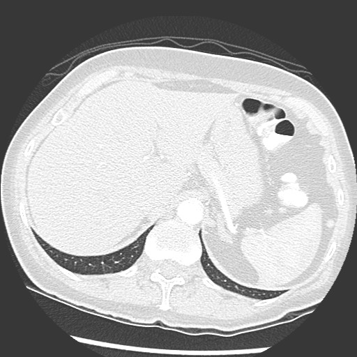Amyloidosis - bronchial and diffuse nodular pulmonary involvement (Radiopaedia 60156-67745 Axial lung window 82).jpg