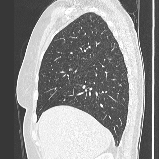 Amyloidosis - bronchial and diffuse nodular pulmonary involvement (Radiopaedia 60156-67745 Sagittal lung window 24).jpg
