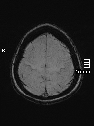 File:Amyotrophic lateral sclerosis (Radiopaedia 70821-81017 Axial SWI 48).jpg