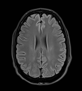 File:Amyotrophic lateral sclerosis (Radiopaedia 87352-103658 Axial FLAIR 20).jpg