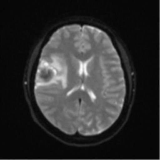Anaplastic astroblastoma (Radiopaedia 55666-62194 Axial DWI 17).png