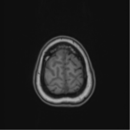 Anaplastic astroblastoma (Radiopaedia 55666-62194 Axial T1 68).png