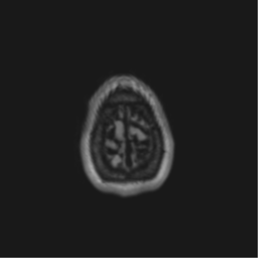 File:Anaplastic astrocytoma IDH mutant (Radiopaedia 50046-55341 Axial FLAIR 46).png