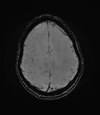File:Anaplastic astrocytoma IDH mutant (Radiopaedia 50046-55341 Axial SWI 69).png