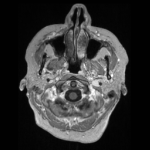 Anaplastic astrocytoma IDH wild-type (pseudoprogression) (Radiopaedia 42209-45276 Axial T1 C+ 14).png