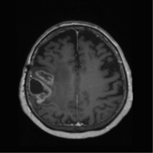 File:Anaplastic astrocytoma IDH wild-type (pseudoprogression) (Radiopaedia 42209-45278 Axial T1 C+ 108).png