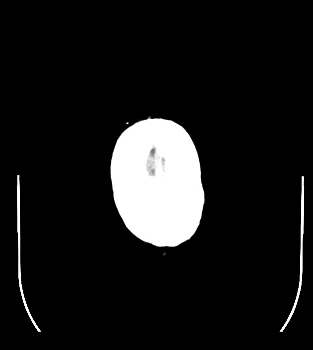Anaplastic oligodendroglioma (Radiopaedia 79571-92755 Axial non-contrast 51).jpg