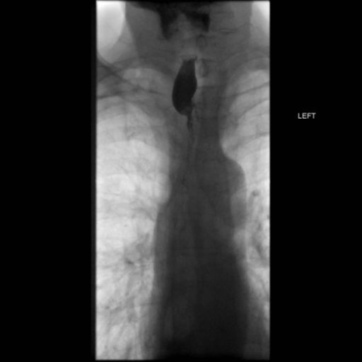 File:Anastomotic stricture post Ivor Lewis esophagectomy (Radiopaedia 47937-52715 B 11).png