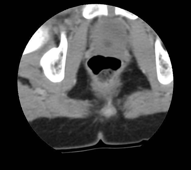 File:Aneurysmal bone cyst - sacrum (Radiopaedia 65190-74195 Axial non-contrast 51).jpg