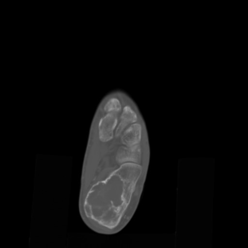 File:Aneurysmal bone cyst of the calcaneus (Radiopaedia 60669-68421 Axial bone window 10).jpg