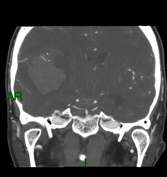 Aneurysmal subarachnoid hemorrhage with intra-axial extension (Radiopaedia 84371-99732 C 52).jpg