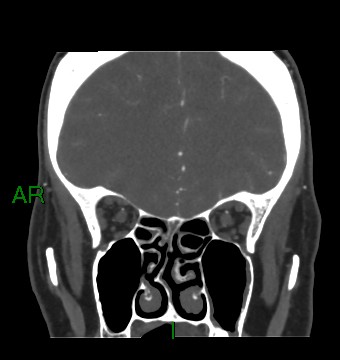 Aneurysmal subarachnoid hemorrhage with intra-axial extension (Radiopaedia 84371-99732 C 73).jpg
