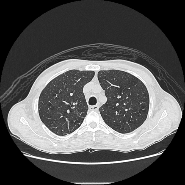 Angioinvasive aspergellosis (Radiopaedia 66995-76315 Axial lung window 12).jpg