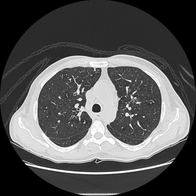 Angioinvasive aspergellosis (Radiopaedia 66995-76315 Axial lung window 17).jpg
