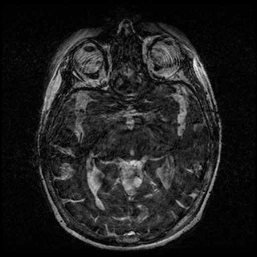 Angioinvasive aspergillosis in the pituitary fossa (Radiopaedia 39676-42010 Ax 3D FIESTA VOLUME 80).png