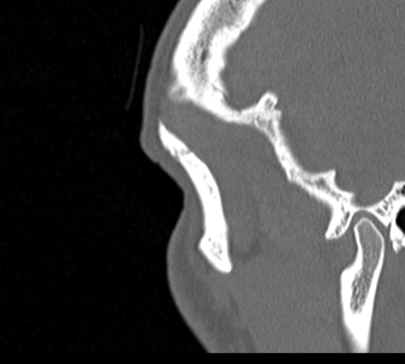 Angular epidermoid cyst (Radiopaedia 46908-51439 Sagittal bone window 95).png