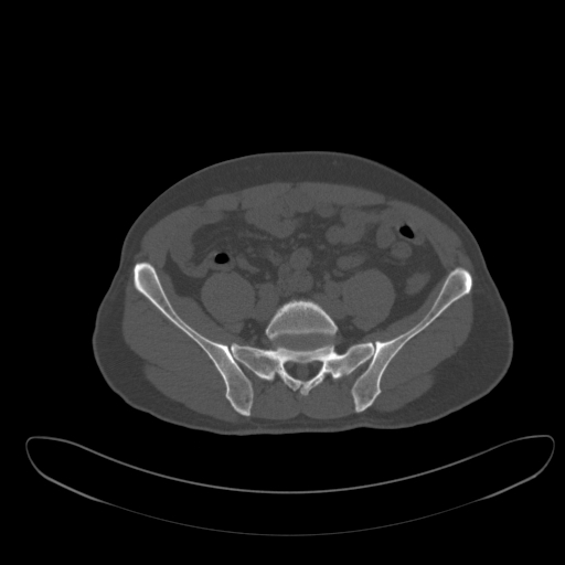 Ankylosing spondylitis (Radiopaedia 52728-58645 Axial bone window 8).jpg