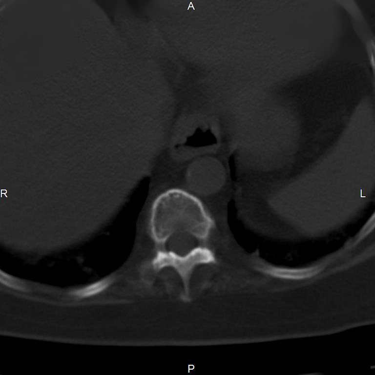 Ankylosing spondylitis (Radiopaedia 8748-9556 Axial bone window 7).jpg