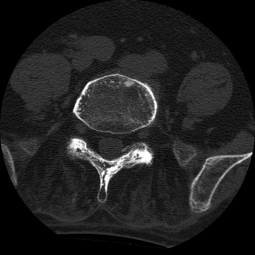 File:Ankylosing spondylitis complicated by fracture-dislocation (Radiopaedia 33583-34674 Axial non-contrast 131).jpg