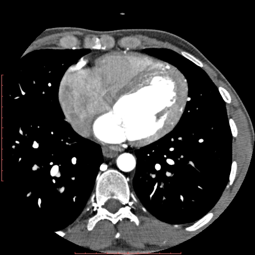 File:Anomalous left coronary artery from the pulmonary artery (ALCAPA) (Radiopaedia 70148-80181 A 226).jpg