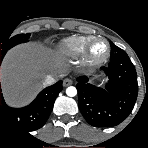 Anomalous left coronary artery from the pulmonary artery (ALCAPA) (Radiopaedia 70148-80181 A 349).jpg