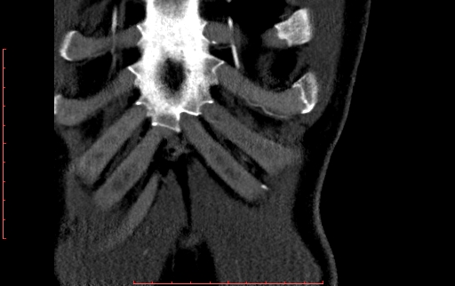 Anomalous left coronary artery from the pulmonary artery (ALCAPA) (Radiopaedia 70148-80181 B 21).jpg