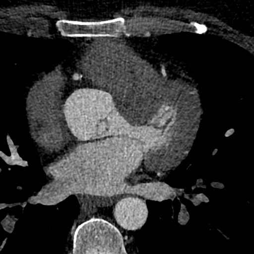 File:Anomalous origin of the left coronary artery with malignant course (Radiopaedia 77842-90126 C 93).jpeg
