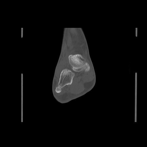 File:Anterior calcaneal process fracture (Radiopaedia 82590-96762 Coronal bone window 48).jpg