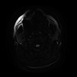 Anterior cerebral artery infarction (Radiopaedia 46794-51323 Axial DWI 1).jpg